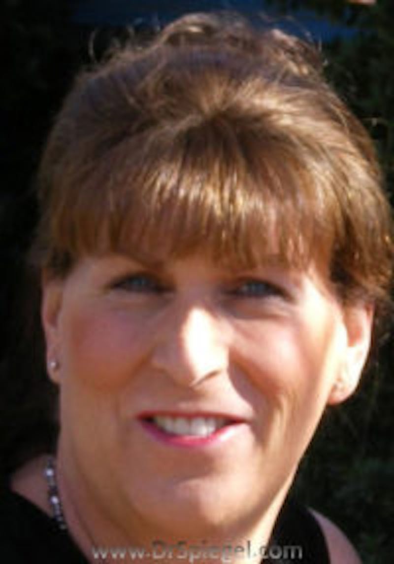 FFS Before & After Gallery - Patient 332739 - Image 2