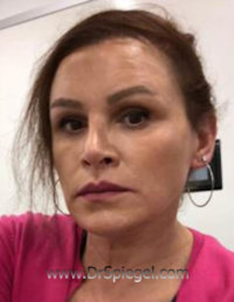 FFS Before & After Gallery - Patient 269678 - Image 2