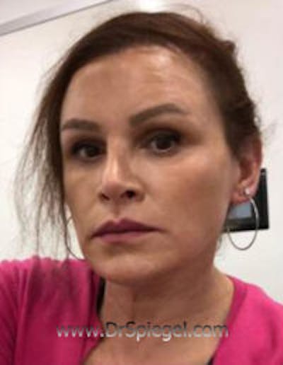 FFS Before & After Gallery - Patient 269678 - Image 2