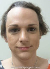 FFS Before & After Gallery - Patient 518246 - Image 1
