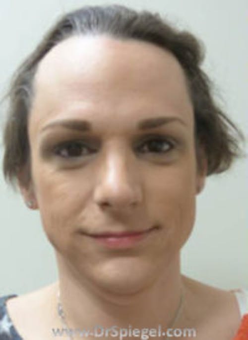 FFS Before & After Gallery - Patient 518246 - Image 1