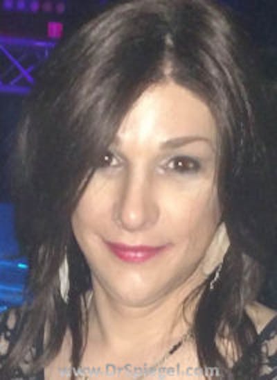 FFS Before & After Gallery - Patient 518246 - Image 2