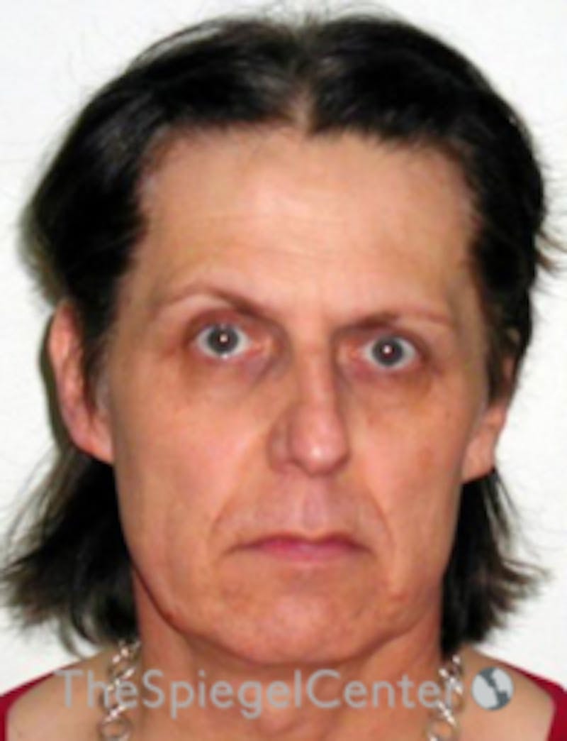 FFS Before & After Gallery - Patient 352313 - Image 1