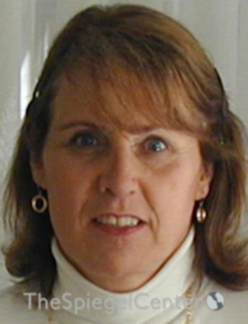 FFS Before & After Gallery - Patient 352313 - Image 2