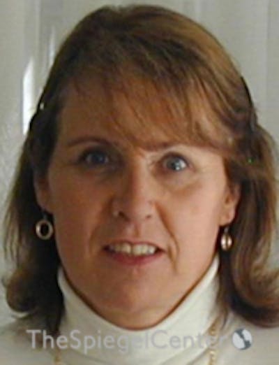 FFS Before & After Gallery - Patient 352313 - Image 2