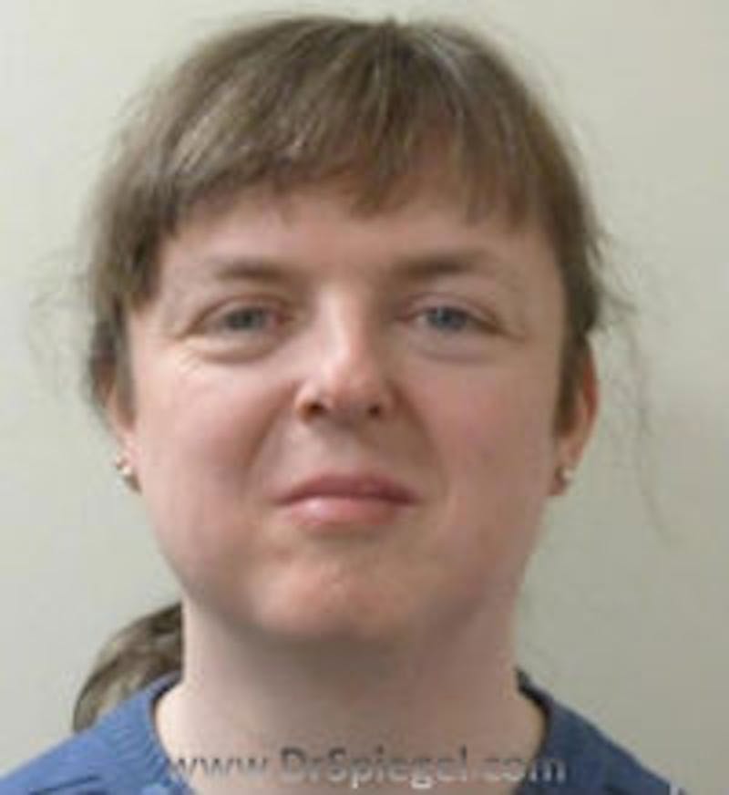 FFS Before & After Gallery - Patient 280454 - Image 1