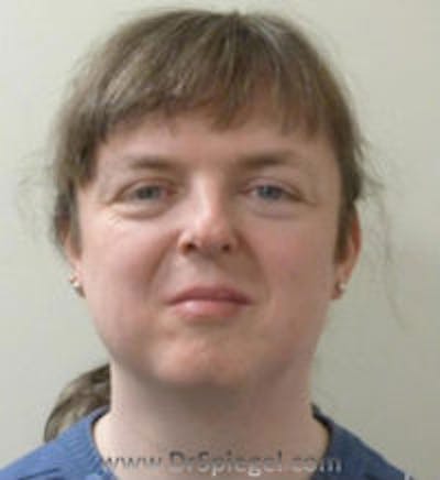 FFS Before & After Gallery - Patient 280454 - Image 1