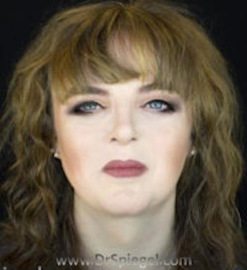 FFS Before & After Gallery - Patient 280454 - Image 2