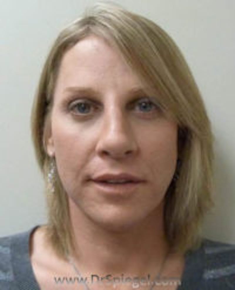 FFS Before & After Gallery - Patient 303443 - Image 2