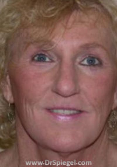 FFS Before & After Gallery - Patient 535244 - Image 2