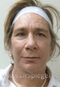 FFS Before & After Gallery - Patient 191196 - Image 1