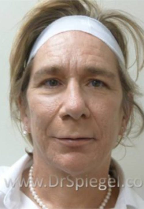 FFS Before & After Gallery - Patient 191196 - Image 1