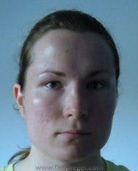 FFS Before & After Gallery - Patient 148098 - Image 1