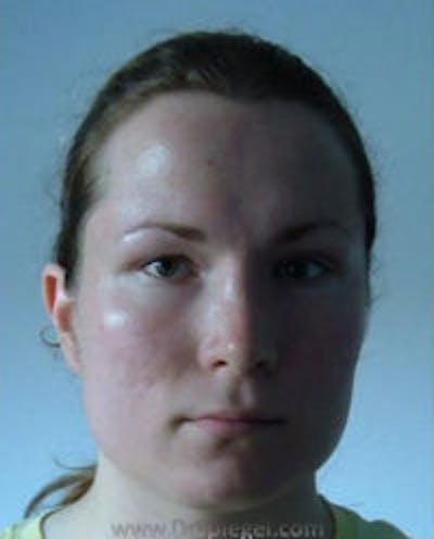 FFS Before & After Gallery - Patient 148098 - Image 1