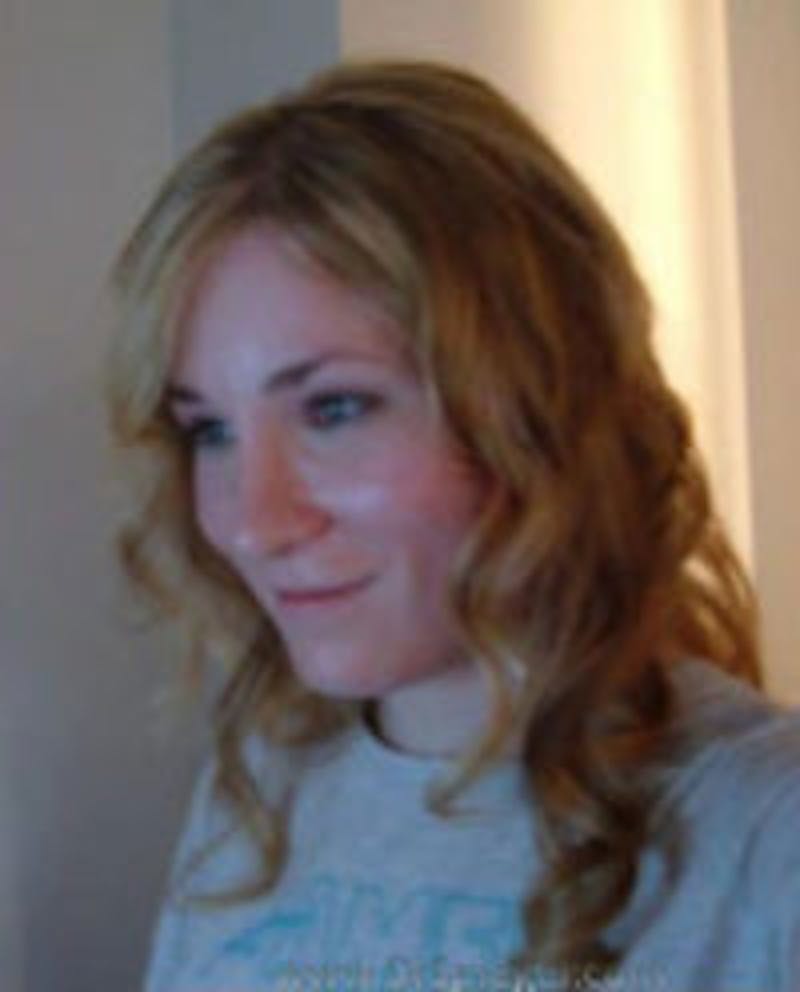 FFS Before & After Gallery - Patient 148098 - Image 2