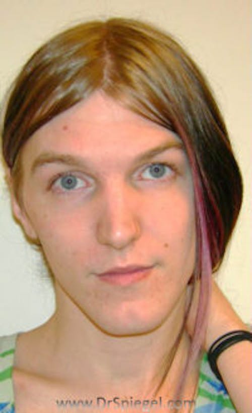 FFS Before & After Gallery - Patient 225140 - Image 1