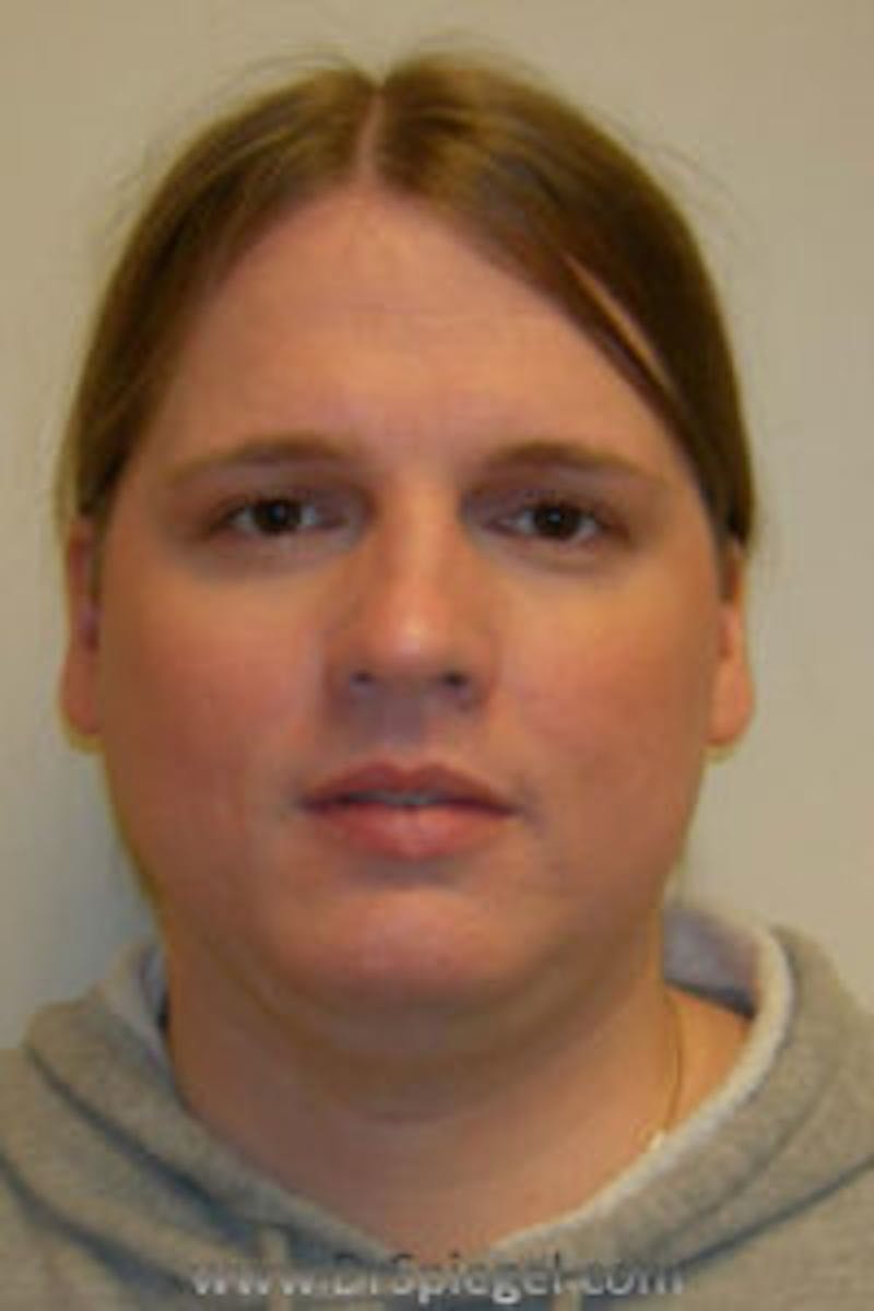 FFS Before & After Gallery - Patient 258178 - Image 1