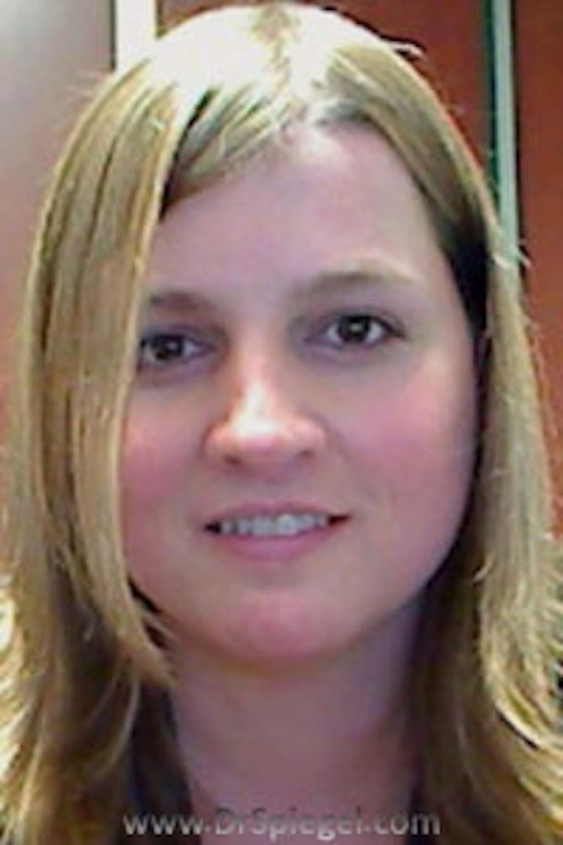 FFS Before & After Gallery - Patient 258178 - Image 2