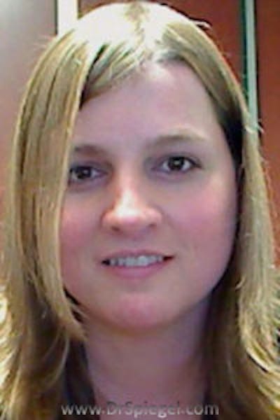 FFS Before & After Gallery - Patient 258178 - Image 2