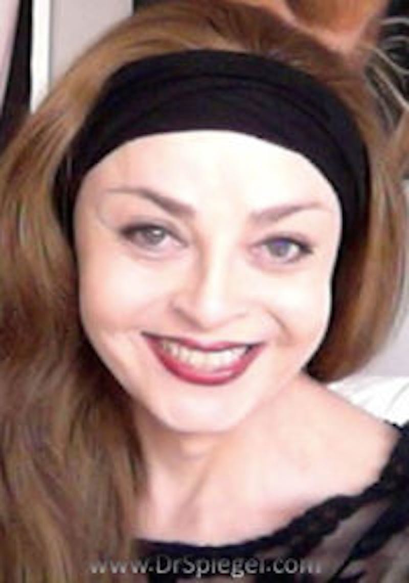 FFS Before & After Gallery - Patient 206210 - Image 2