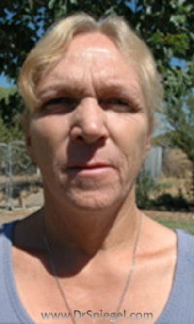 FFS Before & After Gallery - Patient 326355 - Image 1