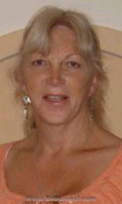 FFS Before & After Gallery - Patient 326355 - Image 2