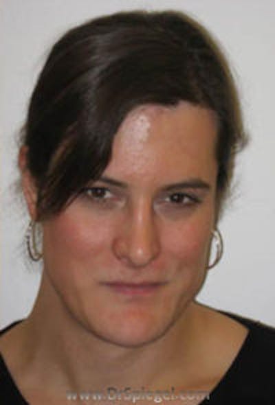 FFS Before & After Gallery - Patient 404959 - Image 2