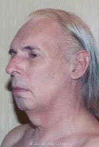FFS Before & After Gallery - Patient 169869 - Image 1