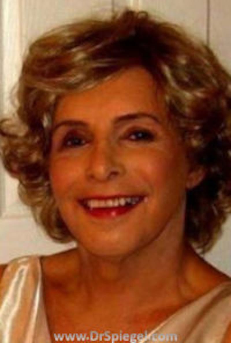 FFS Before & After Gallery - Patient 169869 - Image 2