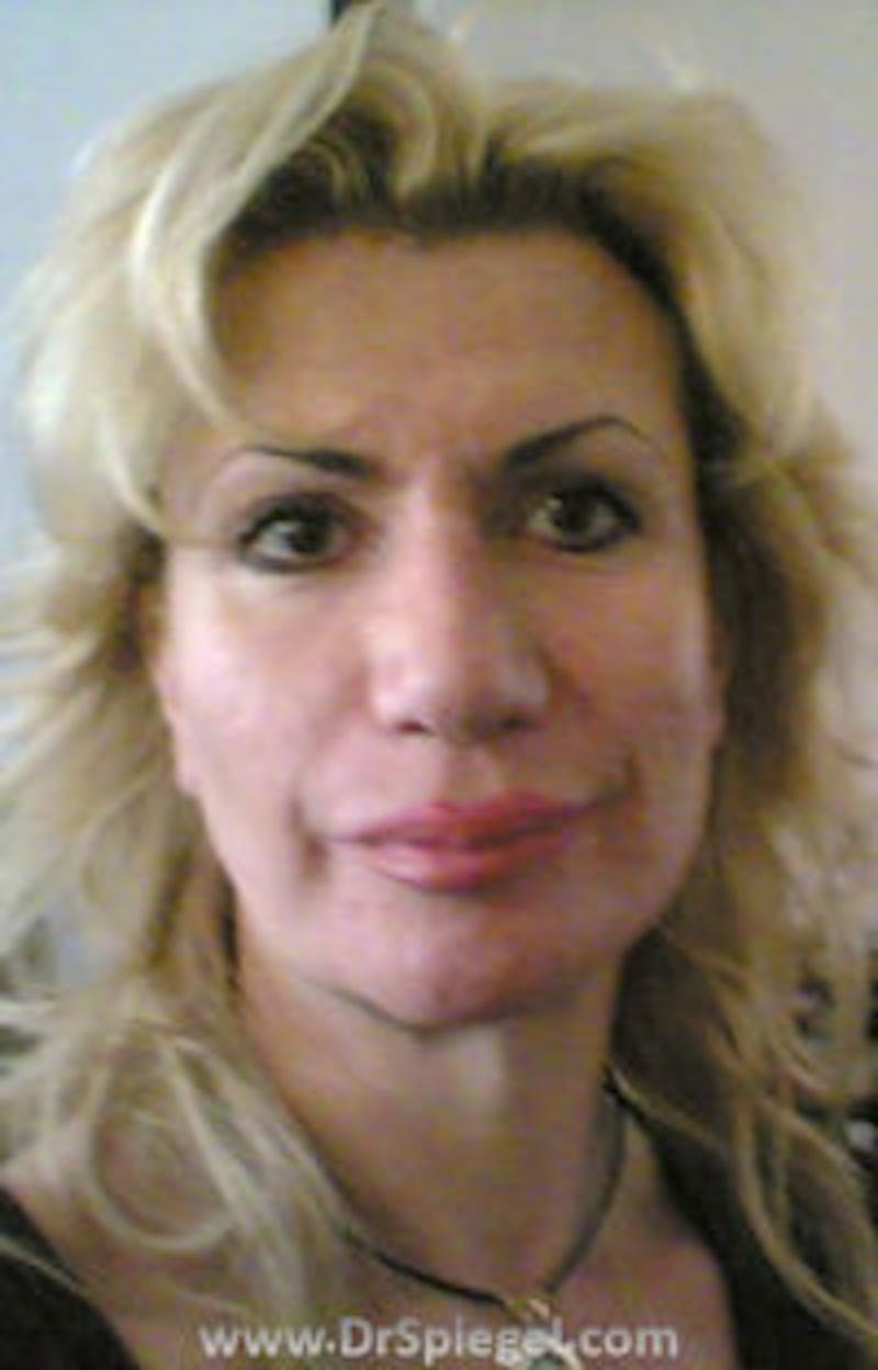 FFS Before & After Gallery - Patient 156628 - Image 1