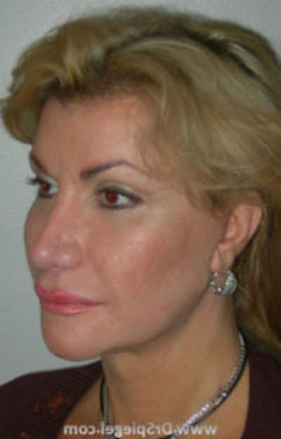 FFS Before & After Gallery - Patient 156628 - Image 2