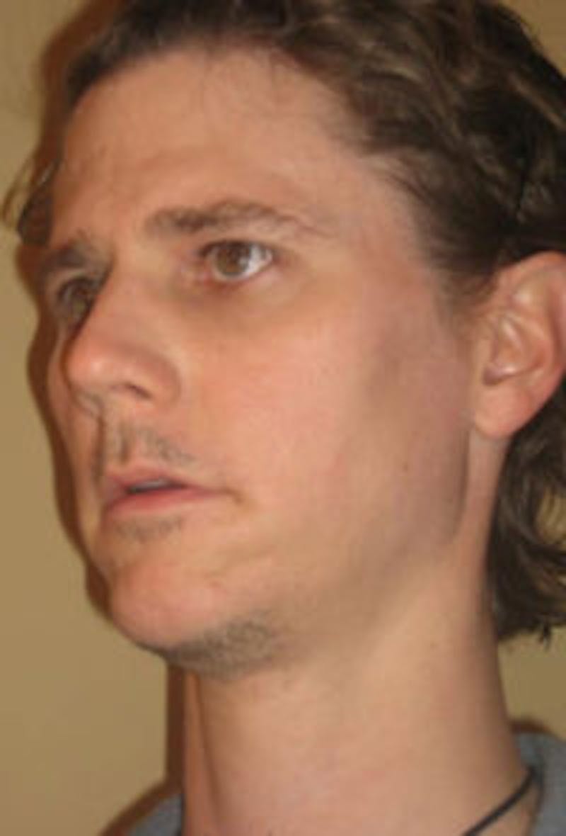 FFS Before & After Gallery - Patient 394706 - Image 1