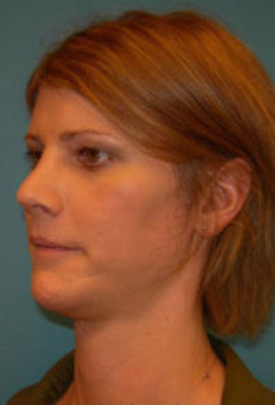 FFS Before & After Gallery - Patient 394706 - Image 2