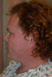 FFS Before & After Gallery - Patient 403873 - Image 1