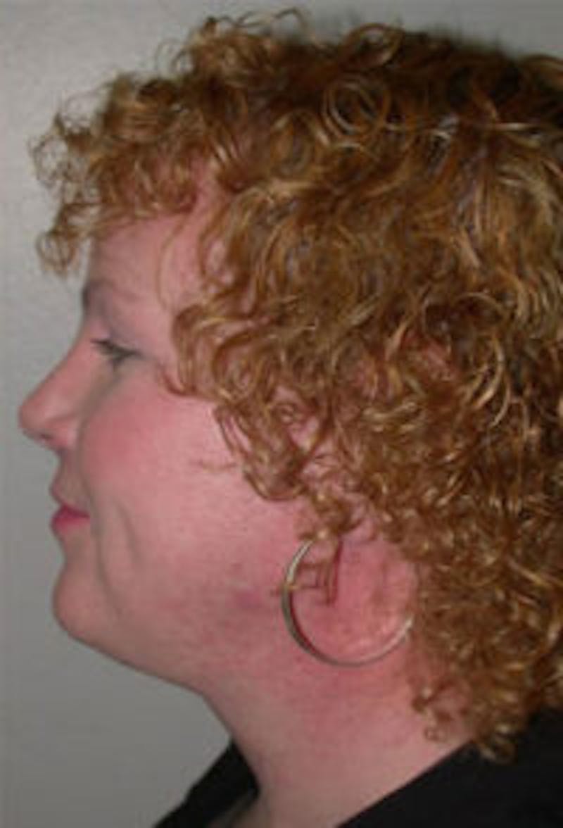 FFS Before & After Gallery - Patient 403873 - Image 2