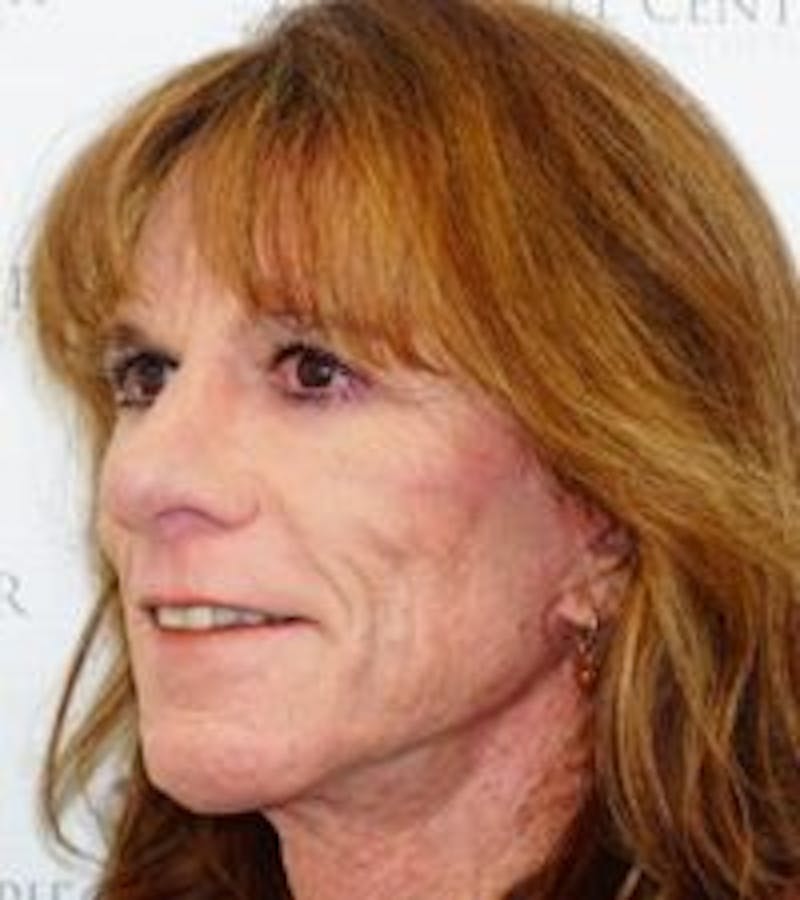 FFS Non-Surgical Feminization Before & After Gallery - Patient 122536 - Image 1