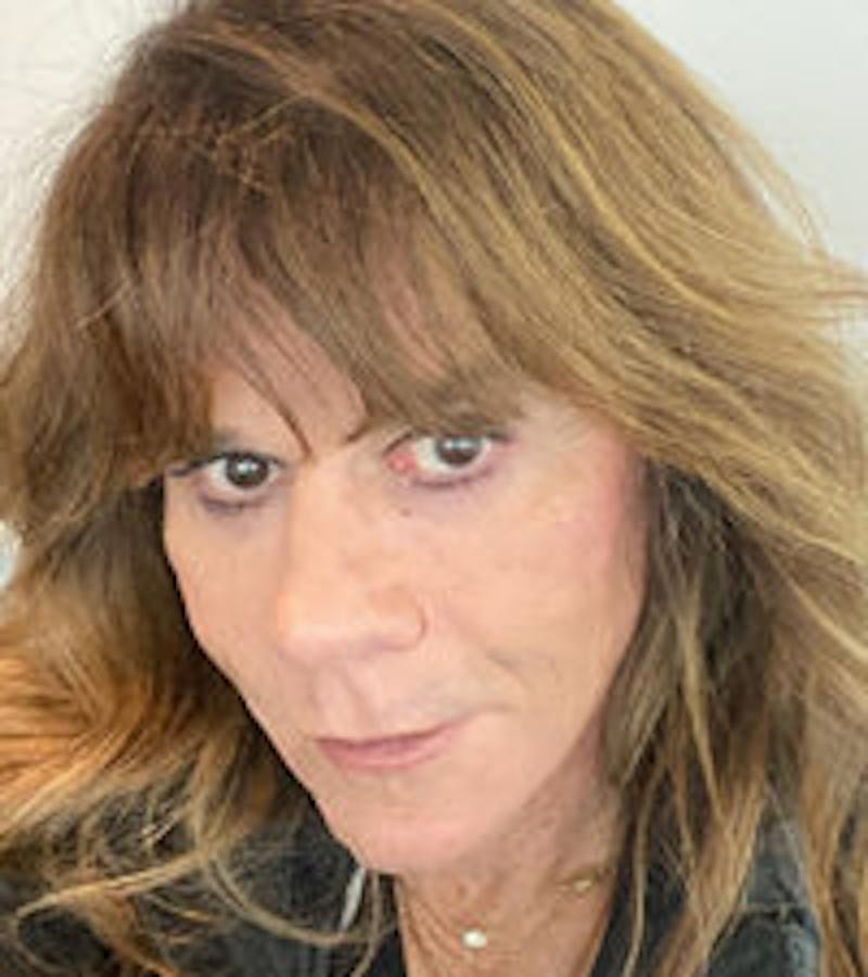 FFS Non-Surgical Feminization Before & After Gallery - Patient 122536 - Image 2