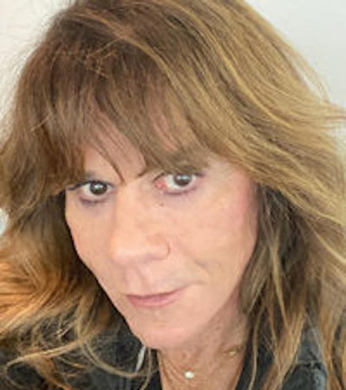 FFS Non-Surgical Feminization Before & After Gallery - Patient 122536 - Image 2