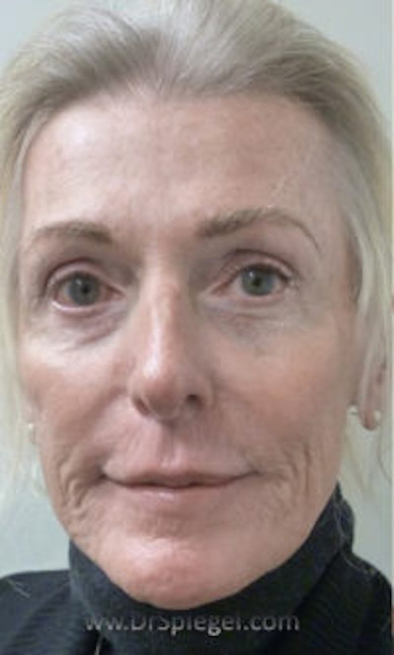 FFS Non-Surgical Feminization Before & After Gallery - Patient 909960 - Image 1