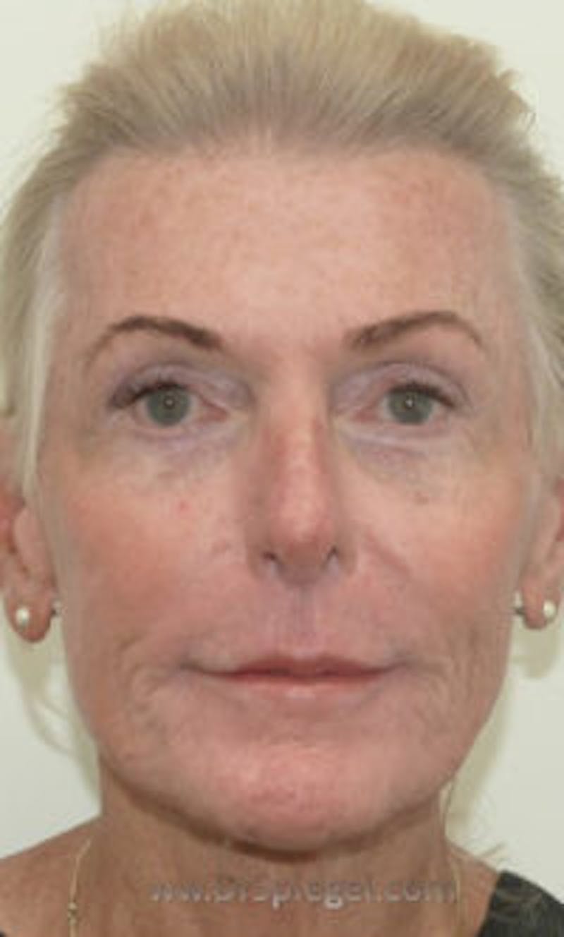 FFS Non-Surgical Feminization Before & After Gallery - Patient 909960 - Image 2