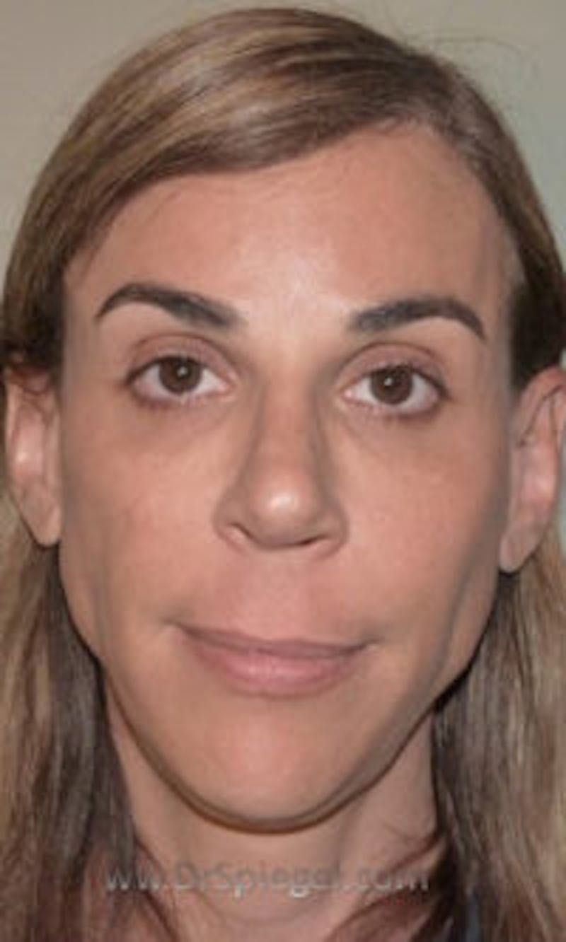 FFS Non-Surgical Feminization Before & After Gallery - Patient 350974 - Image 1