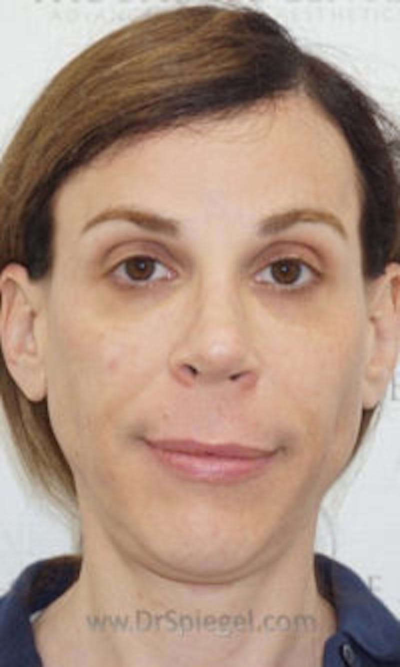 FFS Non-Surgical Feminization Before & After Gallery - Patient 350974 - Image 2