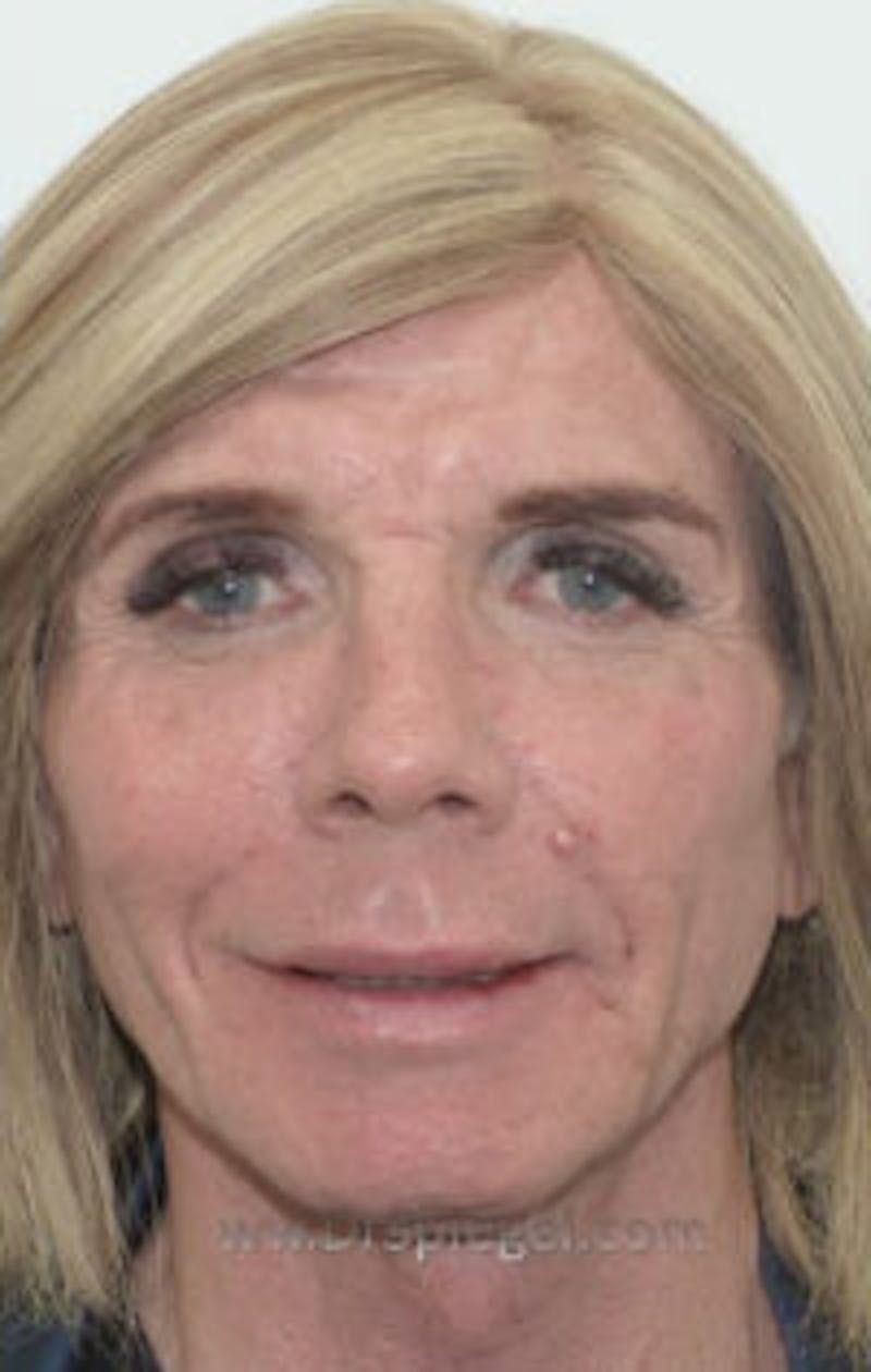 FFS Non-Surgical Feminization Before & After Gallery - Patient 237753 - Image 2