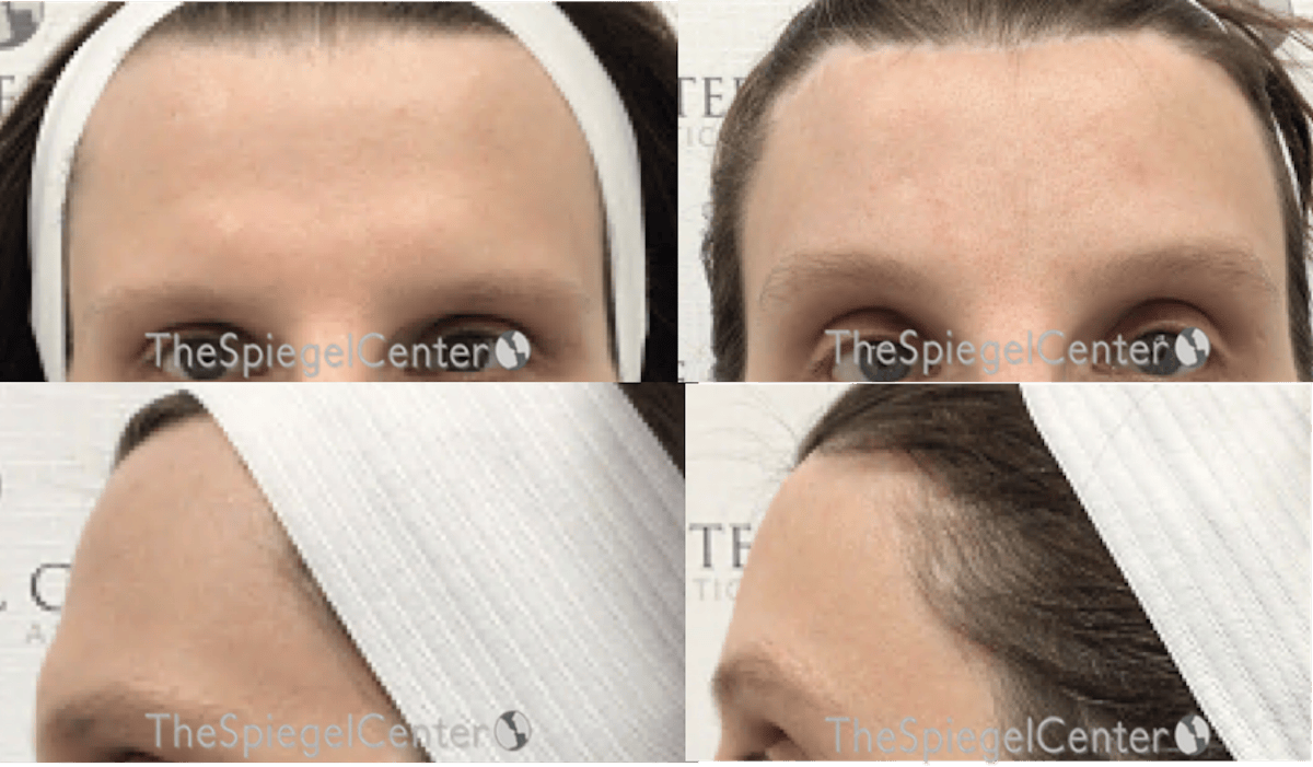FFS Scalp Advancement Before & After Gallery - Patient 235013 - Image 1