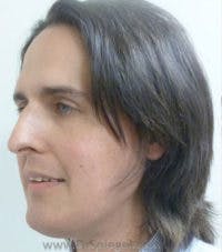 Scalp Advancement Before & After Gallery - Patient 164685 - Image 1