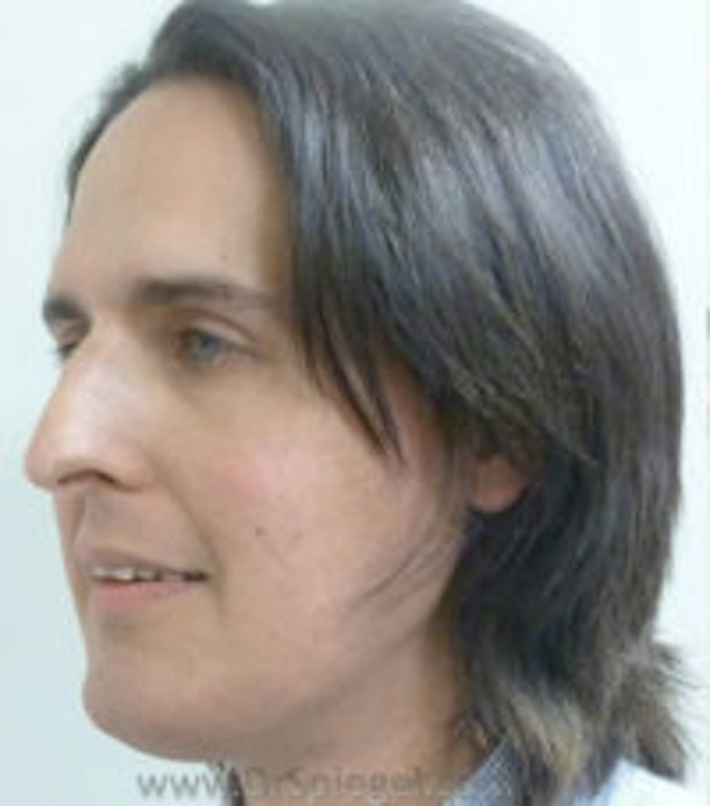 Hairline Advancement