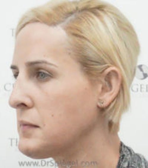 Scalp Advancement Before & After Gallery - Patient 164685 - Image 2