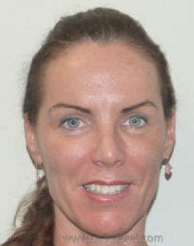 Scalp Advancement Before & After Gallery - Patient 316750 - Image 1