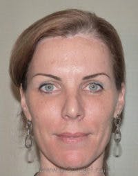 Scalp Advancement Before & After Gallery - Patient 225792 - Image 2