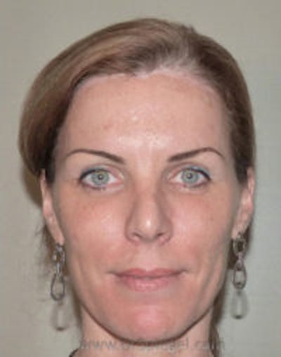 Scalp Advancement Before & After Gallery - Patient 316750 - Image 2